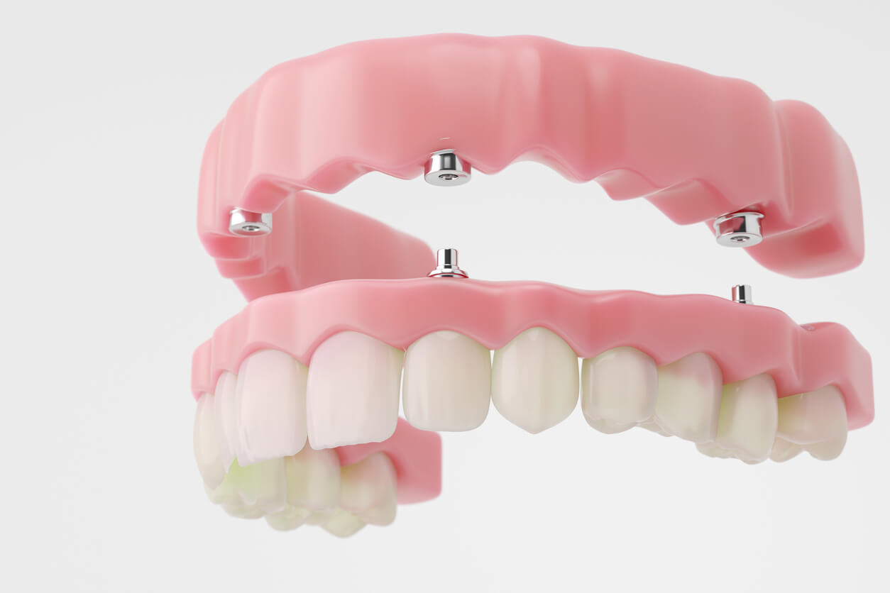 Snap-on dentures solution at Fusion Dental Implants Roseville CA
